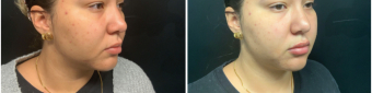 lip-enhancement-nyc-before-after-1-3