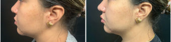 lip-enhancement-nyc-before-after-1-4