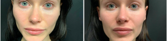 lip-enhancement-nyc-before-after-2-1