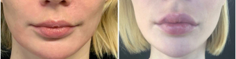 lip-enhancement-nyc-before-after-3-1