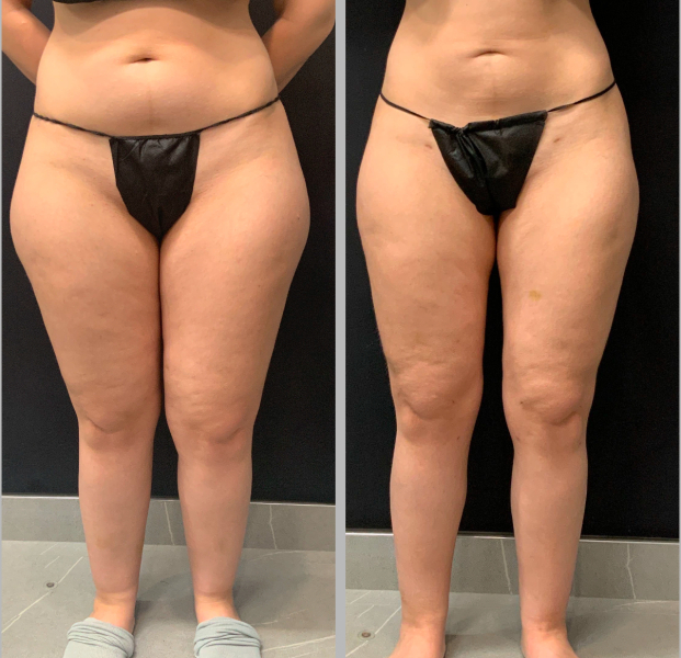 lipedema-plastic-surgery-nyc-before-after-1-1