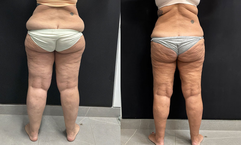 lipedema-plastic-surgery-nyc-before-after-photo-22