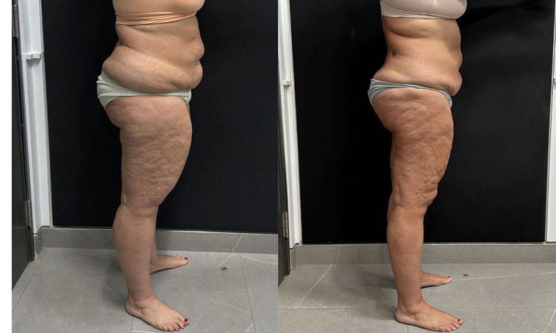 lipedema-plastic-surgery-nyc-before-after-photo-24