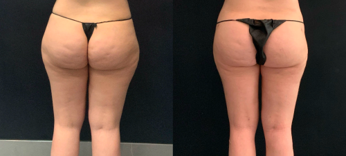 Lipedema-plastic-surgery-nyc-before-after-1-1