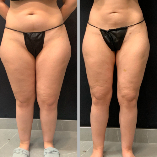 Lipedema-plastic-surgery-nyc-before-after-1-2