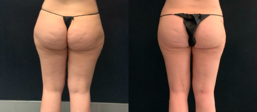 lipedema-plastic-surgery-nyc-before-after-1-2