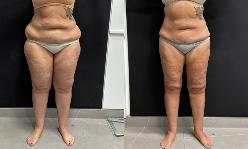 lipedema-plastic-surgery-nyc-before-after-photo-21