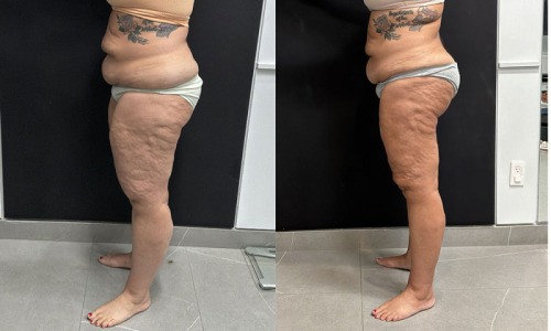 lipedema-plastic-surgery-nyc-before-after-photo-23