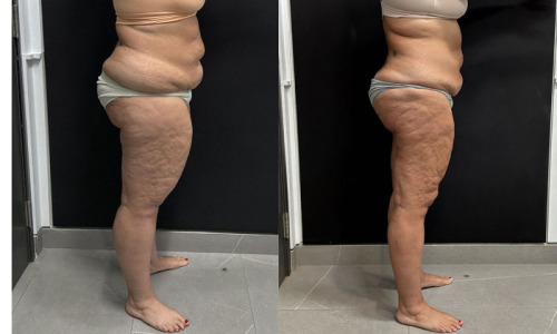 lipedema-plastic-surgery-nyc-before-after-photo-24