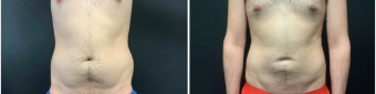 men-liposuction-fat-transfer-nyc-before-after-1-1