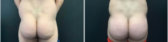 men-liposuction-fat-transfer-nyc-before-after-1-4