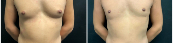 gynecomastia-liposuction-sugery-nyc-before-after-1-1