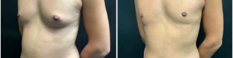 gynecomastia-liposuction-sugery-nyc-before-after-1-5