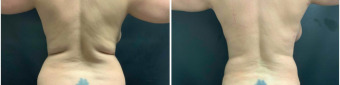 liposuction-surgery-nyc-before-after-1-4