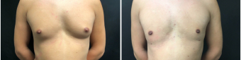 liposuction-surgery-nyc-before-after-2-1