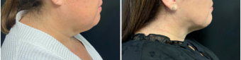 liposuction-surgery-nyc-before-after-3-1