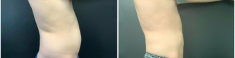 men-liposuction-surgery-nyc-before-after-1-3