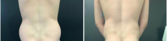 men-liposuction-surgery-nyc-before-after-1-5