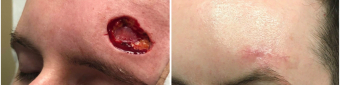 mohs-surgery-nyc-before-after-2-1