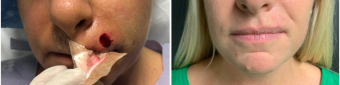 mohs-surgery-nyc-before-after-4-1