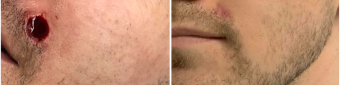 mohs-surgery-nyc-before-after-5-1