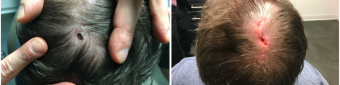 mohs-surgery-nyc-before-after-6-1