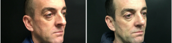 rhinoplasty-surgery-nyc-before-after-1-3