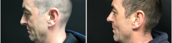 rhinoplasty-surgery-nyc-before-after-1-5