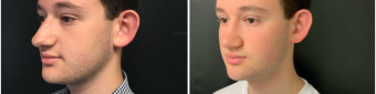 rhinoplasty-surgery-nyc-before-after-2-2