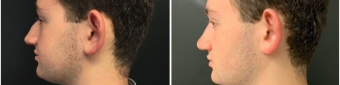 rhinoplasty-surgery-nyc-before-after-2-3