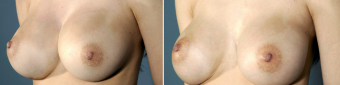 symmastia-before-after-photo-10