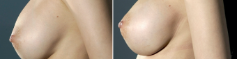 symmastia-before-after-photo-12