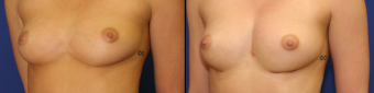 symmastia-before-after-photo-2