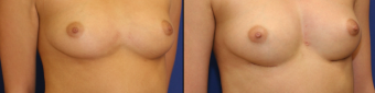 symmastia-before-after-photo-3