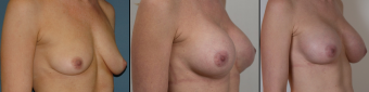 symmastia-before-after-photo-5