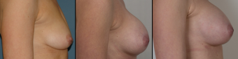 symmastia-before-after-photo-8